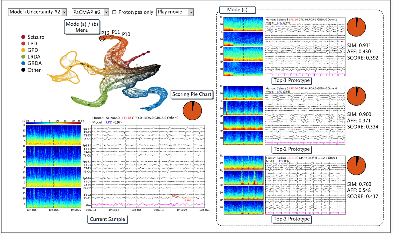 EEG Pattern Classification with AI